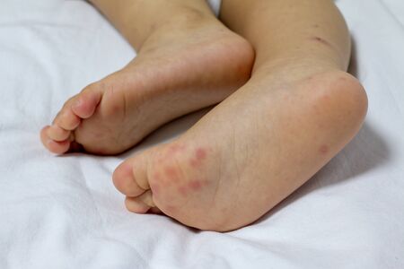 Allergic rash skin of baby's right foot. (Hand Foot and Mouth disease)の写真素材
