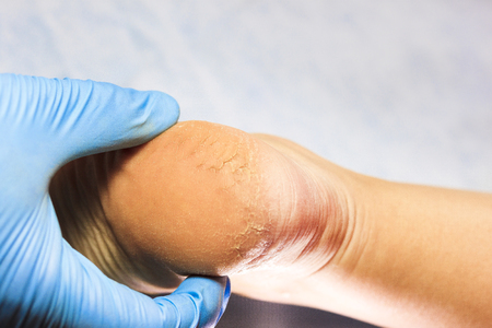 the doctor examines the patient's leg in blue gloves. The heel is all blistered and cracked. close-up.の写真素材