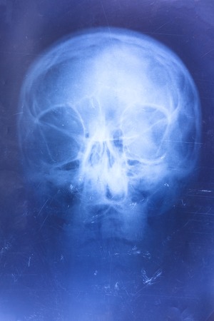 X-ray of the skull. retro shot. possibly concussion.の写真素材