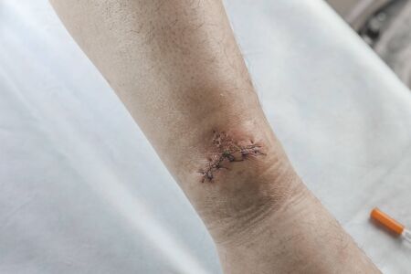 a doctor in blue gloves examines a wound on his leg. there is a cut and sewn with threadsの写真素材