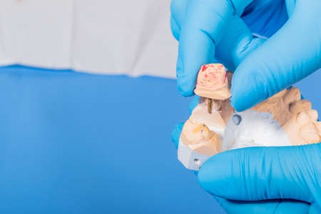 Studio lighting. a man in blue gloves holds a plaster jaw. Close-upの写真素材