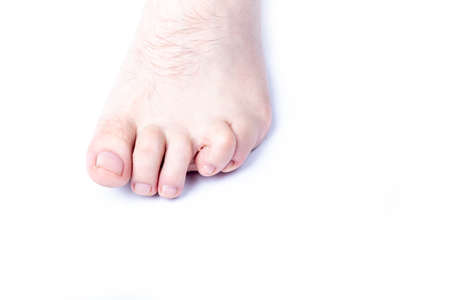 studio lighting. a human leg on a white background. The finger is strongly curved, deformed. Close-upの写真素材