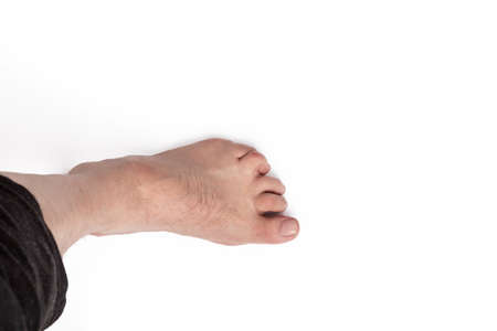 studio lighting. a human leg on a white background. The finger is strongly curved, deformed. Close-upの写真素材