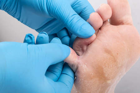 studio lighting. a human leg on a white background. A doctor in blue gloves examines the legs with a fungal infection of the leg. Close-up.の写真素材