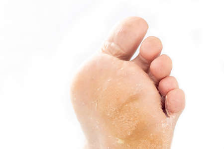 studio lighting. a human leg on a white background. A doctor in blue gloves examines the legs with a fungal infection of the leg. Close-up.の写真素材