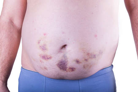 on a white background. a man in underpants. the stomach is covered in bruises. close-up.の写真素材