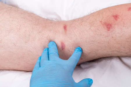 male legs with hair are lying on a white sheet. there are many small redness.