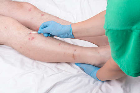 male legs with hair are lying on a white sheet. there are many small redness.