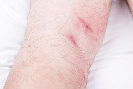 male legs with hair are lying on a white sheet. there are many small redness.の写真素材