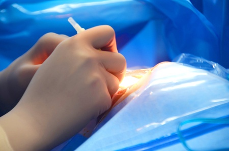 Eye surgery の写真素材