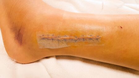 fresh stitches in the leg (ankle) after operation. Ankle surgery scar with staples. Broken ankle with surgery scarの写真素材