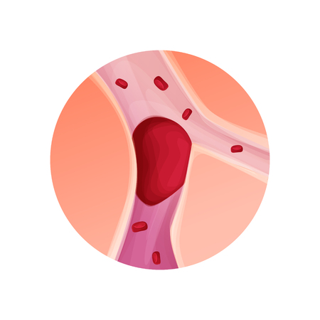 Blocked blood vessel, artery with blood clot realistic vector illustration isolated backgroundのイラスト素材