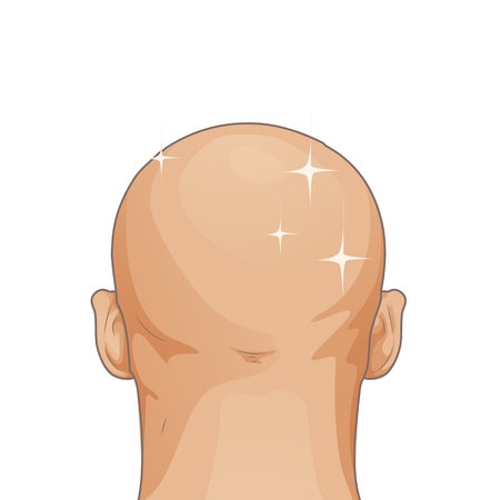 Girl with hair loss problem isolated on white background, cartoon styleのイラスト素材