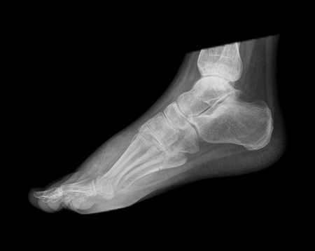 foot x-rayの写真素材