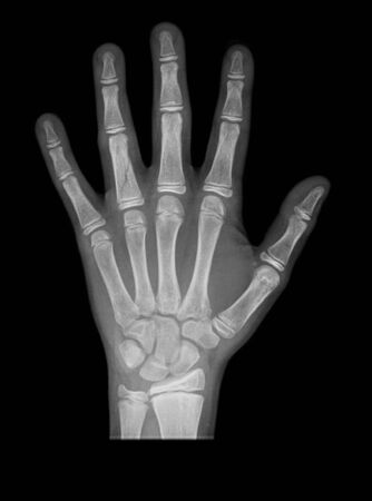 hand x-rayの写真素材