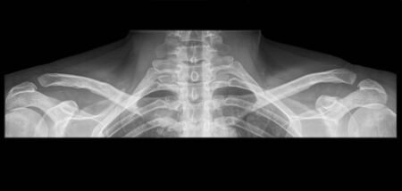 shoulder x-rayの写真素材