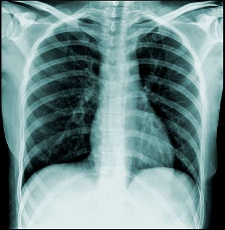 chest x-ray, front view (thorax)