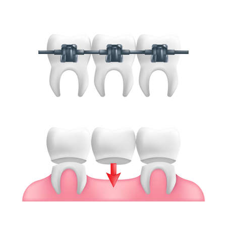 Denture concept - healthy teeth with a fixed dental bridgework and braces on top of them. Vector illustration of human teeth in a 3d realistic style isolated on a white backgroundのイラスト素材