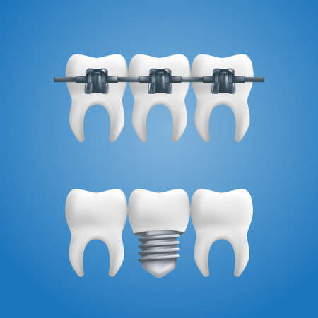 Denture concept - healthy teeth with a dental implant and braces on top of them. Vector illustration of human teeth in a 3d realistic style isolated on a blue backgroundのイラスト素材