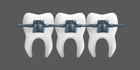 Teeth with metal braces. Orthodontic treatment concept. 3d realistic vector illustration of a dental ceramic model isolated on a gray backgroundのイラスト素材