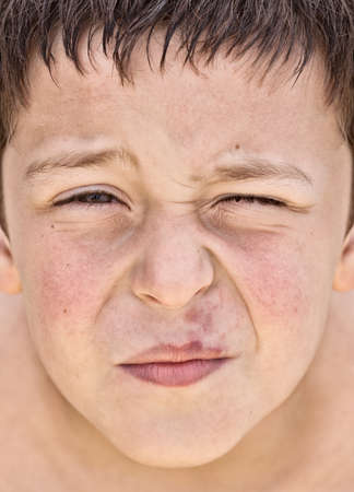 Young Boy With A Herpes On His Lipの写真素材