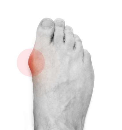 Varus valgus and Hallux valgus, bunion on white background. With clipping pathの写真素材