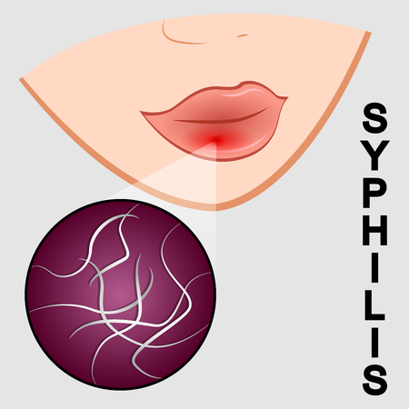 Illustration of syphilis. symptoms and causative agent.のイラスト素材