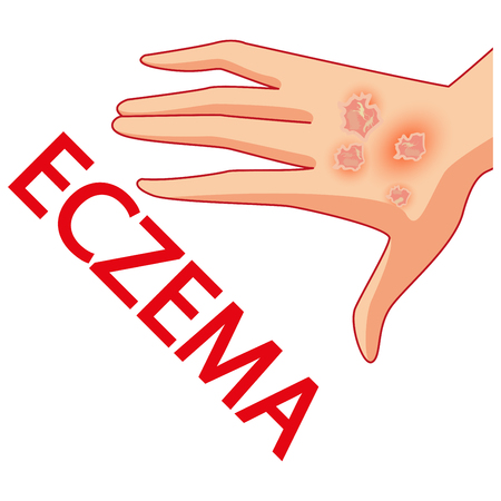 Psoriasis. Skin problems. Vector. Cartoon. Isolated. Flat. Illustration for websites, brochures, magazines. Medicine.のイラスト素材