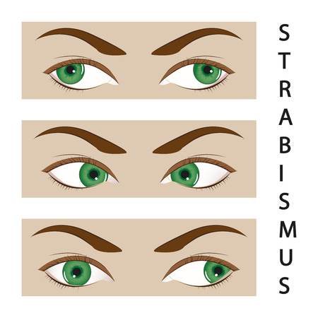 Strabismusのイラスト素材