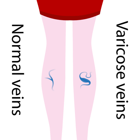 Vector varicose vein and normal vein. Slender and beautiful female legs. Varicose vein.のイラスト素材