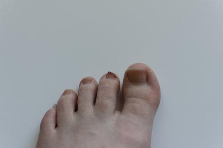 A white foot showing the second or long toe with a bloody and bruised nail