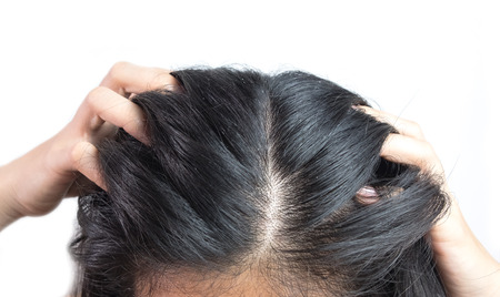 women head with dandruff Caused by the problem of dirty. Or caused by skin disease or Seborrheic...