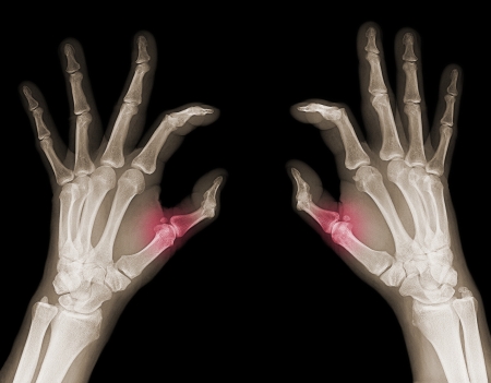 X-rays of hands of an adult man with visible damageの写真素材