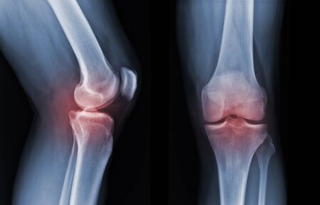 X-ray knee radiograph show state of injuryの写真素材