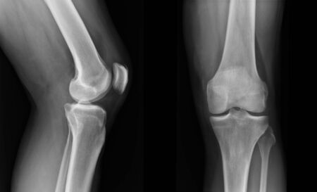 X-ray knee radiograph show state of injuryの写真素材
