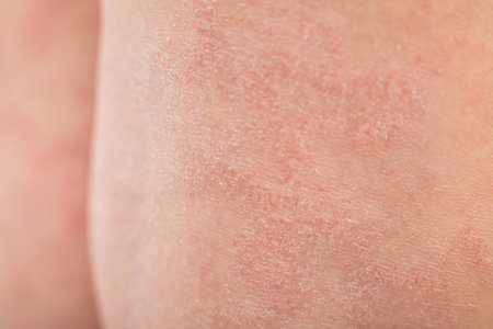 Close-up severe atopic eczema on the legs behind the knees of a child is a dermatological disease of the skin. Large, red, inflamed, scaly rash on the legs. Legs of a teenager with severe atopic dermatitis.Selective focusの写真素材