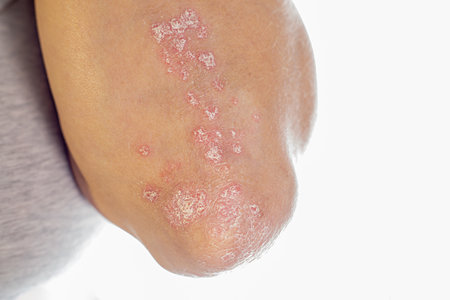 Psoriasis on elbows. Close up autoimmune incurable dermatological skin disease psoriasis. Inflamed, flaky rash on elbows. Joints affected by psoriatic arthritis.の写真素材