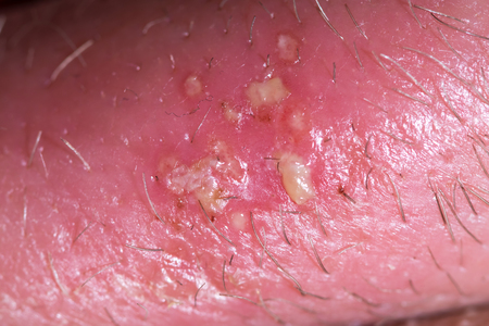 Herpes on the human body. Genital herpes.の写真素材
