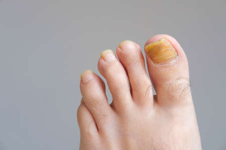 Twisted and deformed big toemail of a manの写真素材