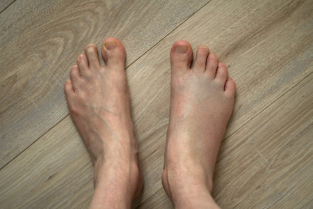 Swollen Injured Foot Next to Healthy Foot. Comparison of injured and healthy feet. Swelling visible,...