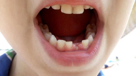 The first milk tooth fell out. Teeth in the mouth of a child.の写真素材