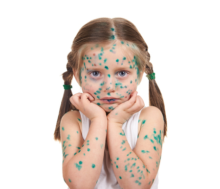 child has the virus on skin, white backgroundの写真素材