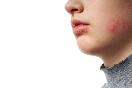 Allergic reaction, skin rash, close view portrait of a girl's face. Redness and inflammation of the...