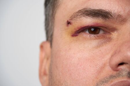 close view of a bruise near the eye, the face of a man with a hematomaの写真素材