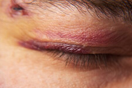 close view of a bruise near the eye, the face of a man with a hematomaの写真素材