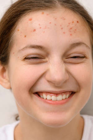 face of a teenage girl with pimples, acne on the skin, portrait of a teen girl, she touches her forehead with her handの写真素材