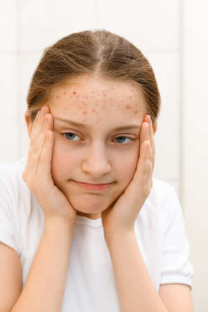 the face of a teenage girl, she looks at herself in the mirror and touches her face with her hand,...