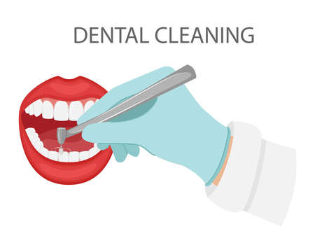 Dental cleaning of teeth. A gloved hand holds a dental polishing drill.Cosmetic and aesthetic dentistry. Professional appointment with dentist.Open mouth with teeth and lips. flat vector illustrationのイラスト素材