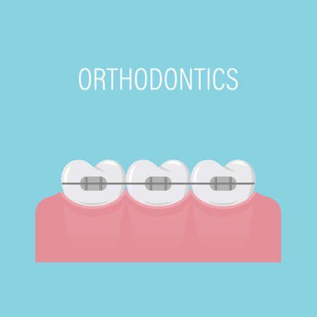 Alignment of teeth with braces. Poster with teeth in braces. Simple white healthy teeth in a row. Orthodontic treatment. Isolated vector illustration. Flat style.のイラスト素材