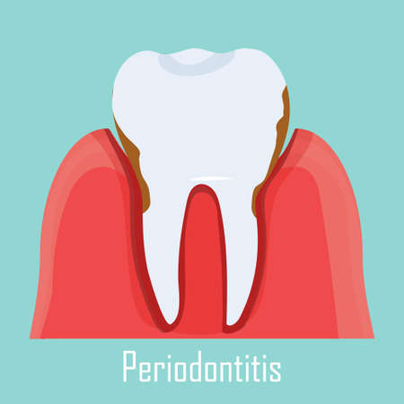 Periodontitis problem, gum sick. Illustration of human tooth with dental inflammation isolated. ....